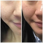孕期收毛孔（孕妇收缩毛孔）