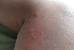 孕期腿上痒（孕期腿上痒的不行,越挠越痒,挠起好多很小的疙瘩）