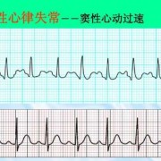 孕妇窦性心律过速110是不是属于正常的啊,孕期窦性心动过速是怎么回事