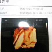 四维显示胎儿左心室强光点要紧吗（四维显示胎儿左心室强光点要紧吗唐氏筛查临界风险）