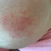 孕期为什么容易得湿疹（孕妇出湿疹怎么办）