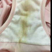 怀孕期间白带发黄怎么办,