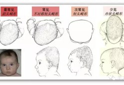 胎儿头太大怎么办（胎儿头偏大多少是畸形）