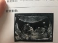 胎儿nt（孕期nt是检查胎儿什么）
