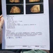 27周胎儿做四维彩超（27周胎儿做四维彩超要憋尿吗）