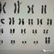 15号染色体缺失会怎样,胎儿15号染色体异常会怎样