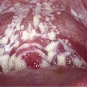 孕妇白带太多怎么办,孕晚期用手抠出一大坨豆腐渣
