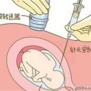 羊穿对胎儿有影响吗（羊穿对胎儿有影响吗?）