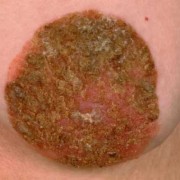 乳头结痂怎么回事,孕期乳头结痂能去掉吗