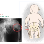 胎儿髋关节（胎儿髋关节脱位四维能发现吗）