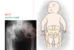胎儿髋关节（胎儿髋关节脱位四维能发现吗）
