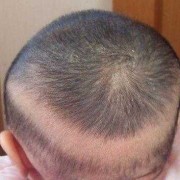宝宝头顶有一块是软的怎么回事,胎儿软指标异常严重吗