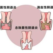 孕期阴道好痒（怀孕外阴痒怎么办）