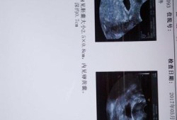 孕期彩超图（孕期彩超图片）
