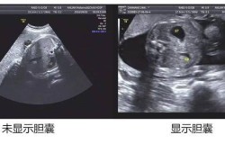 胎儿胆囊大（32周胎儿胆囊偏大38乘以11mm严重吗）