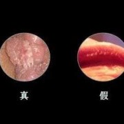 假性湿疣是什么病,孕期假性尖锐疣很痒怎么办