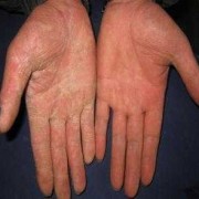 怀孕期间有手癣怎么办（怀孕期间有手癣怎么办啊）