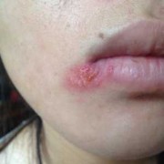 孕妇长疱疹影响胎儿吗（孕中期嘴角长疱疹对胎儿有影响吗）
