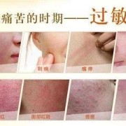 怀孕皮肤过敏庠怎么办,早孕期过敏怎么治疗