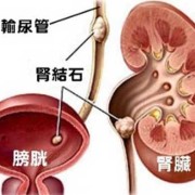 哺乳期肾结石怎么办,胎儿肾结石是怎么形成的