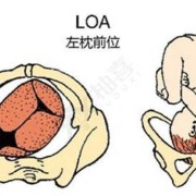 头位loa的胎儿图解（Lorael是什么意思）