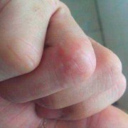 孕期手指湿疹怎么办（孕期手指湿疹怎么办啊）