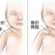 受到挤压胎儿会骨折吗（受到挤压胎儿会骨折吗）