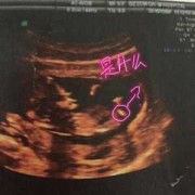 胎儿系统性彩色多普勒（系统性彩色多普勒超声是四维吗）