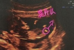 胎儿系统性彩色多普勒（系统性彩色多普勒超声是四维吗）
