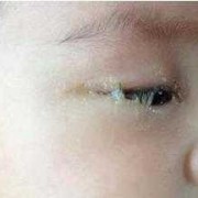 孕期眼屎多（孕期眼屎多怎么回事）
