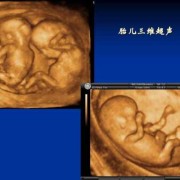 胎儿心脏三维超声心动图是什么,胎儿超声心动图检查有必要做吗