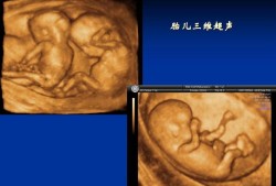 胎儿心脏三维超声心动图是什么,胎儿超声心动图检查有必要做吗
