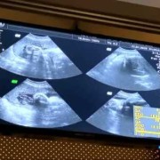 怀孕36周胎宝宝有多大,怀孕36周胎儿彩超检查面部四肢