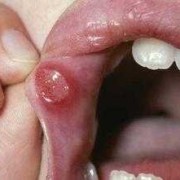 孩子喉咙长口腔溃疡了如何处理,孕期喉咙溃疡怎么办