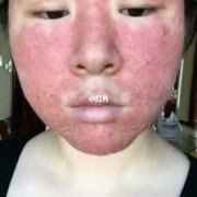 孕期激素皮炎怎么办（激素性皮炎怎么治）