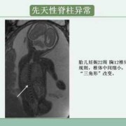 胎儿脊椎排列欠自然是为什么,胎儿脊柱骶尾部相互靠拢且略向后翘