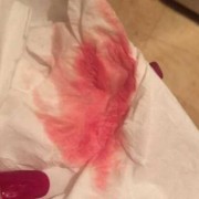 孕期出现褐色分泌物（怀孕后有褐色分泌物正常吗）