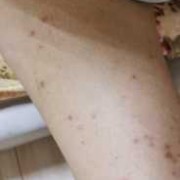怀孕了长湿疹怎么办,孕期为什么会起湿疹的原因
