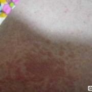 孕期皮肤痒（为什么怀孕后身上老是痒痒呢？晚上的时候特别痒，好难受）