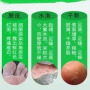 孕期长脚气（孕妇的脚气怎么治？可以抹什么脚气膏）