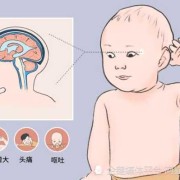 胎儿轻微脑积水怎么办（胎儿轻微脑积水怎么办呢）
