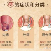 备孕期间痔疮（备孕一定要割痔疮吗）