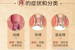 备孕期间痔疮（备孕一定要割痔疮吗）