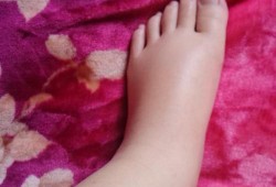 孕期脚肿怎么办（孕期脚肿怎么办?）