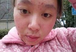 怀孕期间长痘痘怎么办（孕妇脸上起痘怎么办）