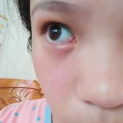 孕妇眼睛肿怎么办,孕期肿胀怎么缓解