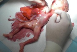 引产后的胎儿怎么处理会更加好些的呢,引产胎儿怎么处理