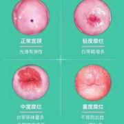 怀孕期间宫颈糜烂出血（怀孕期间宫颈糜烂出血怎么办）