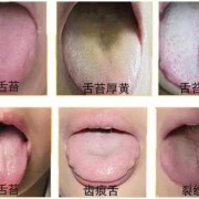 产妇舌苔厚白是怎么办？是不是体内湿气重？吃什么比较好,孕期舌苔厚白是什么原因