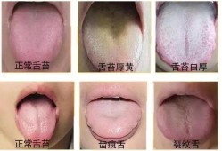 产妇舌苔厚白是怎么办？是不是体内湿气重？吃什么比较好,孕期舌苔厚白是什么原因